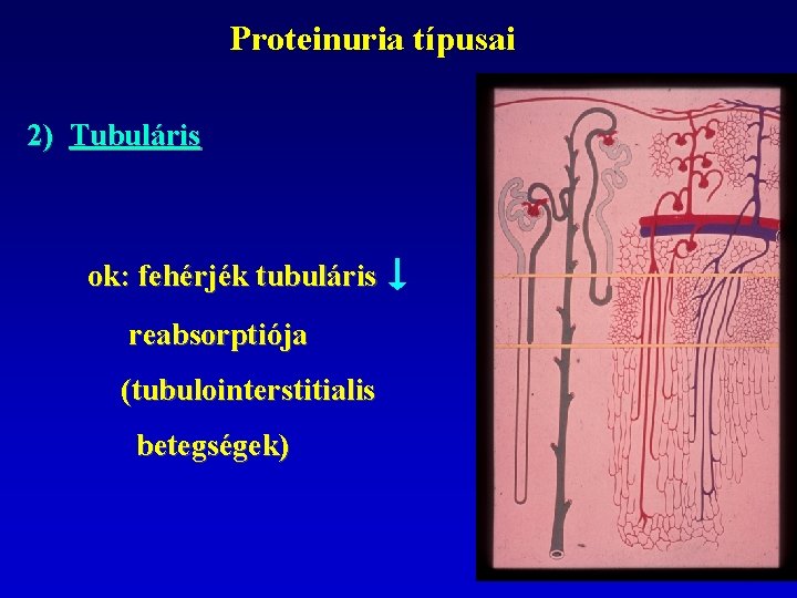 Proteinuria típusai 2) Tubuláris ok: fehérjék tubuláris reabsorptiója (tubulointerstitialis betegségek) 