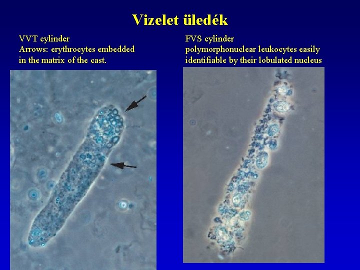 Vizelet üledék VVT cylinder Arrows: erythrocytes embedded in the matrix of the cast. FVS