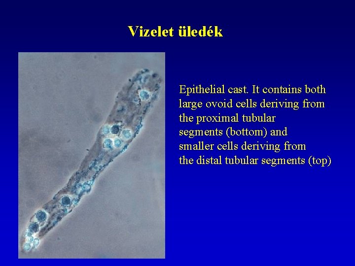 Vizelet üledék Epithelial cast. It contains both large ovoid cells deriving from the proximal