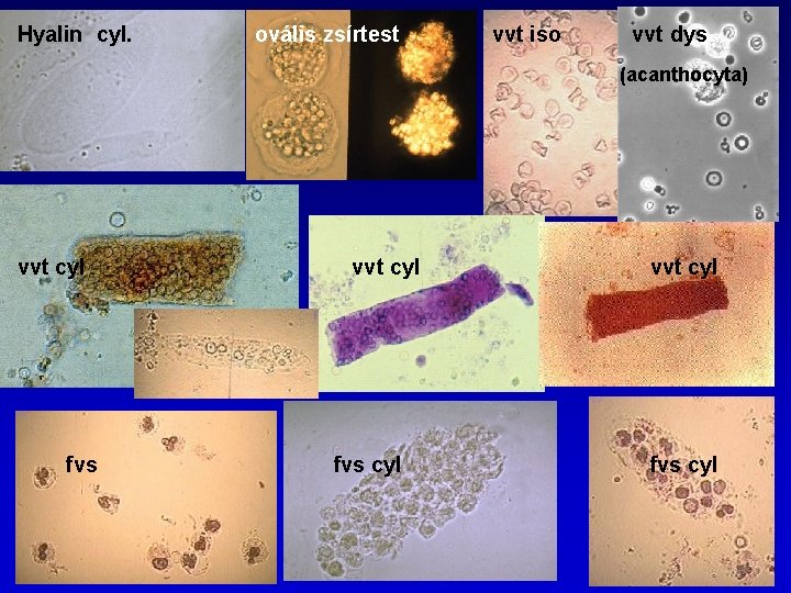 Hyalin cyl. ovális zsírtest vvt iso vvt dys (acanthocyta) vvt cyl fvs cyl 