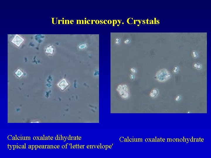 Urine microscopy. Crystals Calcium oxalate dihydrate Calcium oxalate monohydrate typical appearance of 'letter envelope'