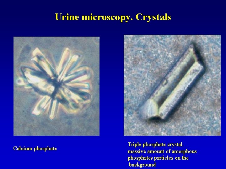 Urine microscopy. Crystals Calcium phosphate Triple phosphate crystal. massive amount of amorphous phosphates particles