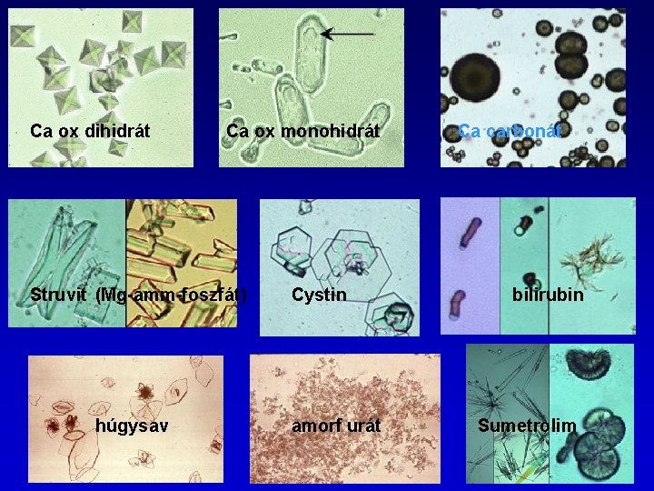 Ca ox dihidrát Ca ox monohidrát Struvit (Mg-amm-foszfát) húgysav Cystin amorf urát Ca carbonát