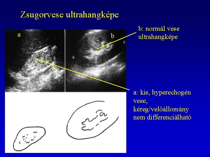 Zsugorvese ultrahangképe a b b: normál vese ultrahangképe a: kis, hyperechogén vese, kéreg/velőállomány nem