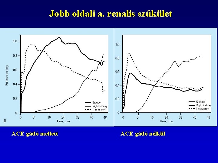 Jobb oldali a. renalis szűkület ACE gátló mellett ACE gátló nélkül 