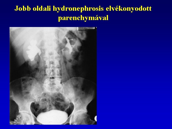 Jobb oldali hydronephrosis elvékonyodott parenchymával 9/2/2021 