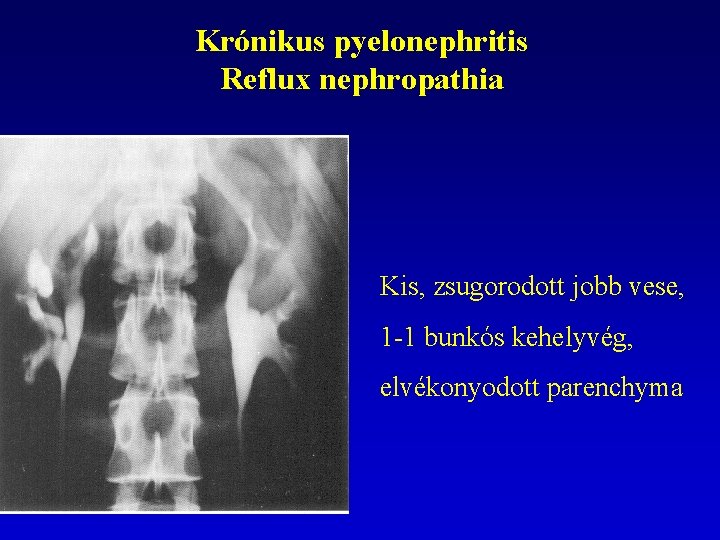 Krónikus pyelonephritis Reflux nephropathia Kis, zsugorodott jobb vese, 1 -1 bunkós kehelyvég, elvékonyodott parenchyma
