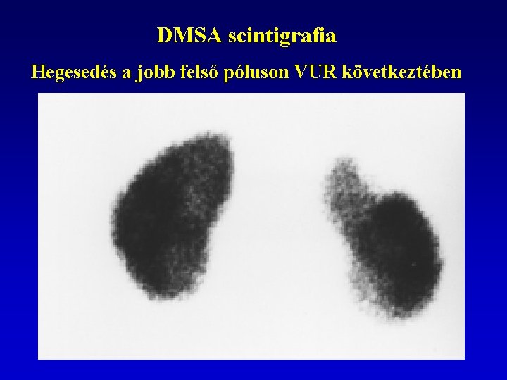 DMSA scintigrafia Hegesedés a jobb felső póluson VUR következtében 