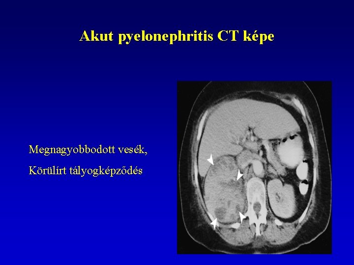 Akut pyelonephritis CT képe Megnagyobbodott vesék, Körülírt tályogképződés 82 