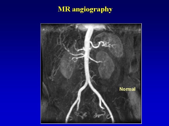 MR angiography Normal 