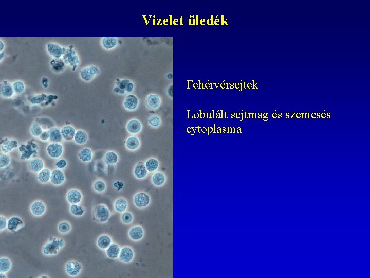 Vizelet üledék Fehérvérsejtek Lobulált sejtmag és szemcsés cytoplasma 