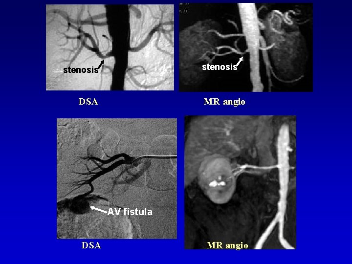 stenosis DSA MR angio AV fistula DSA MR angio 
