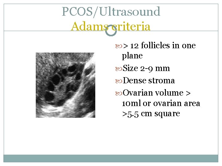 PCOS/Ultrasound Adams criteria > 12 follicles in one plane Size 2 -9 mm Dense