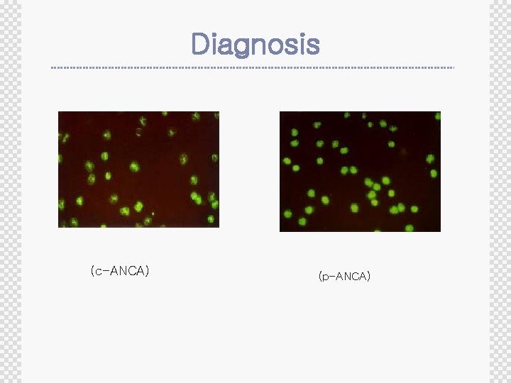 Diagnosis (c-ANCA) (p-ANCA) 