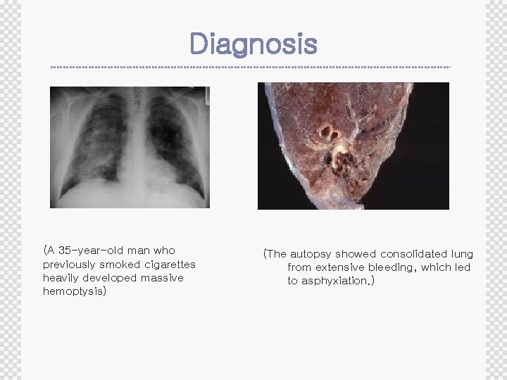 Diagnosis (A 35 -year-old man who previously smoked cigarettes heavily developed massive hemoptysis) (The