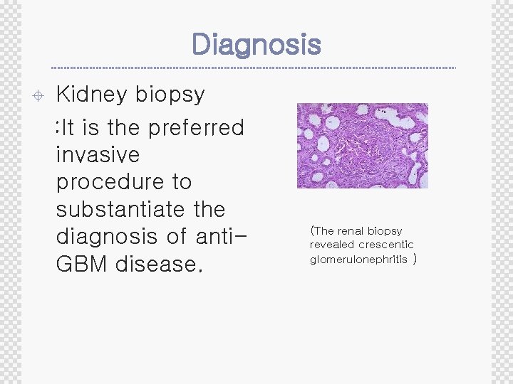 Diagnosis ± Kidney biopsy : It is the preferred invasive procedure to substantiate the