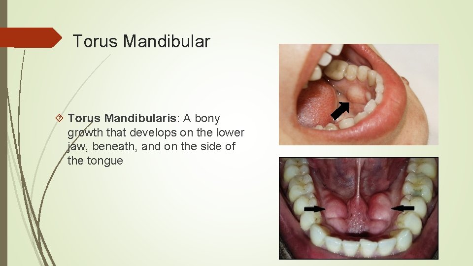 Torus Mandibular Torus Mandibularis: A bony growth that develops on the lower jaw, beneath,