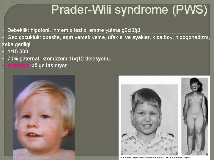 Prader-Wili syndrome (PWS) • Bebeklik: hipotoni, inmemiş testis, emme yutma güçlüğü • Geç çocukluk: