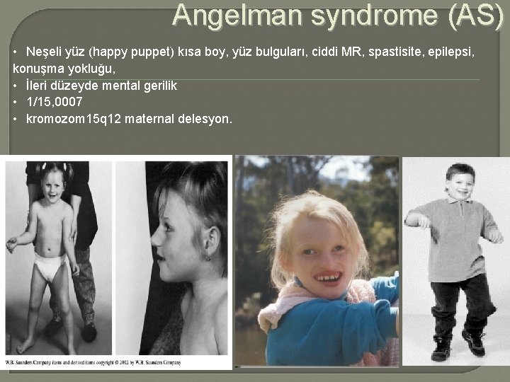 Angelman syndrome (AS) • Neşeli yüz (happy puppet) kısa boy, yüz bulguları, ciddi MR,