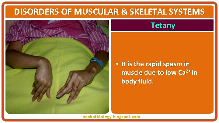 DISORDERS OF MUSCULAR & SKELETAL SYSTEMS Tetany • It is the rapid spasm in