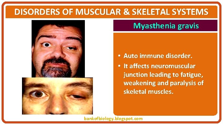 DISORDERS OF MUSCULAR & SKELETAL SYSTEMS Myasthenia gravis • Auto immune disorder. • It