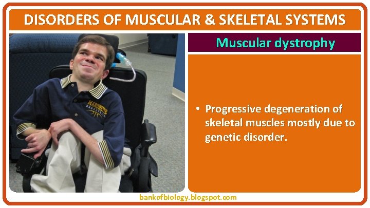 DISORDERS OF MUSCULAR & SKELETAL SYSTEMS Muscular dystrophy • Progressive degeneration of skeletal muscles