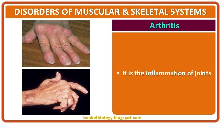 DISORDERS OF MUSCULAR & SKELETAL SYSTEMS Arthritis • It is the inflammation of joints