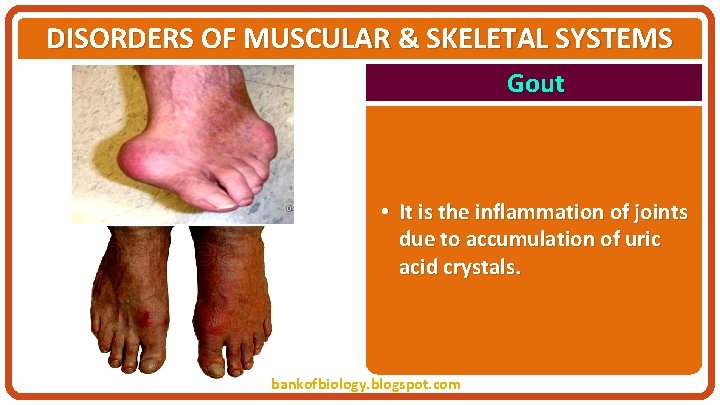 DISORDERS OF MUSCULAR & SKELETAL SYSTEMS Gout • It is the inflammation of joints