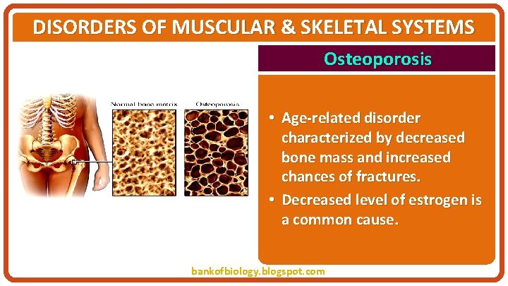 DISORDERS OF MUSCULAR & SKELETAL SYSTEMS Osteoporosis • Age-related disorder characterized by decreased bone