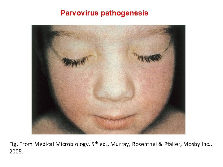 Human Parvoviruses Acknowledgment Addis Ababa University Jimma University