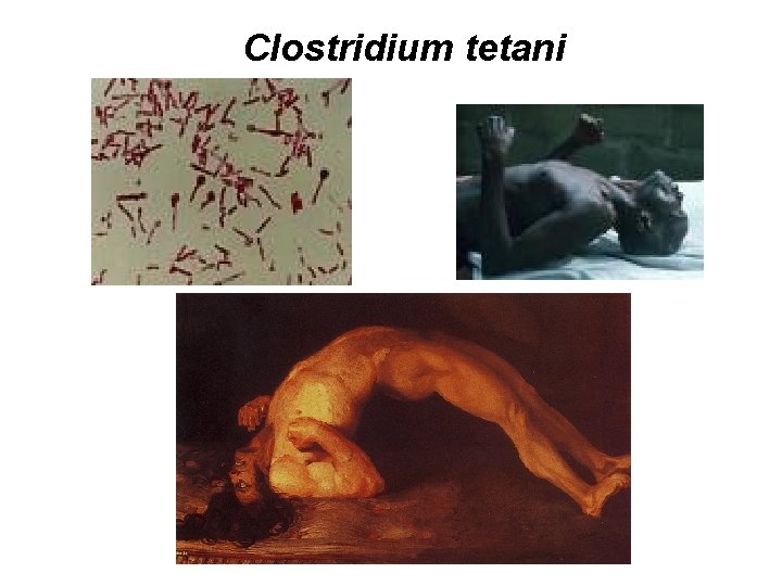 Clostridium tetani 