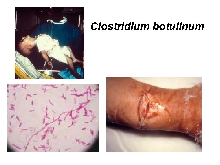 Clostridium botulinum 