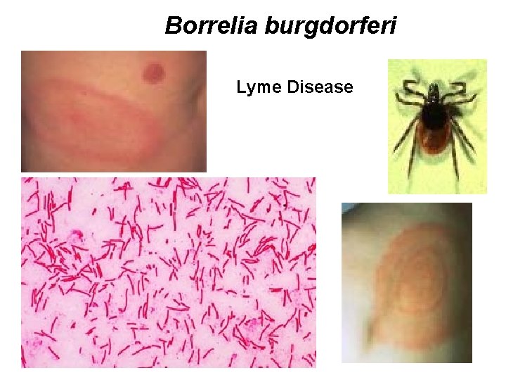 Borrelia burgdorferi Lyme Disease 
