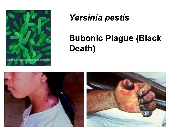 Yersinia pestis Bubonic Plague (Black Death) 