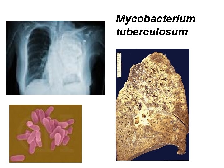 Mycobacterium tuberculosum 