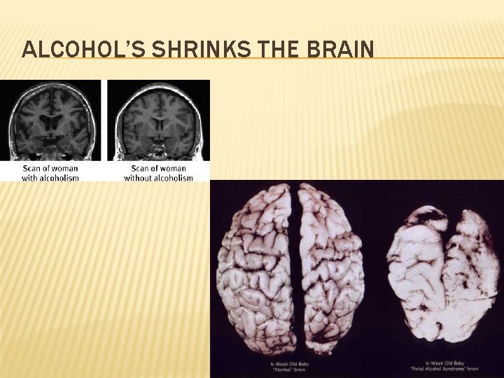 ALCOHOL’S SHRINKS THE BRAIN 