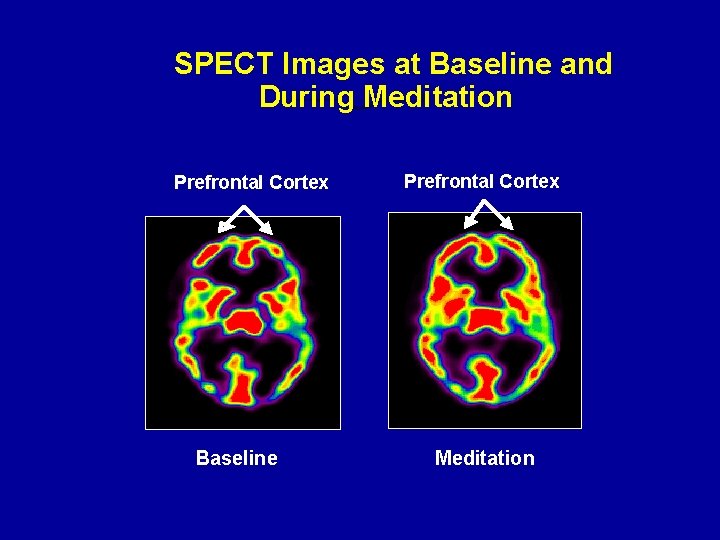 SPECT Images at Baseline and During Meditation Prefrontal Cortex Baseline Prefrontal Cortex Meditation 