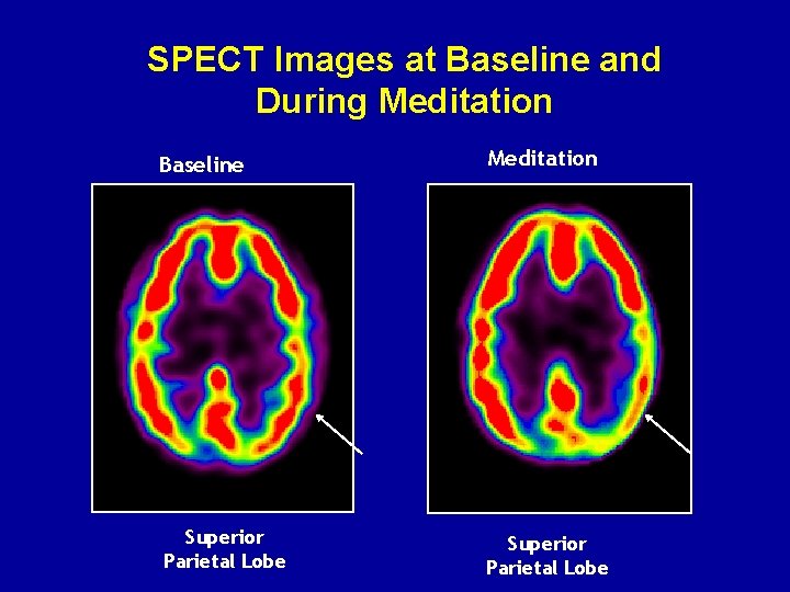 SPECT Images at Baseline and During Meditation Baseline Meditation Superior Parietal Lobe 