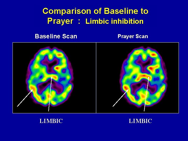 Comparison of Baseline to Prayer : Limbic inhibition Baseline Scan LIMBIC Prayer Scan LIMBIC