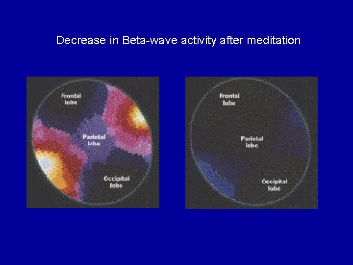 Decrease in Beta-wave activity after meditation 