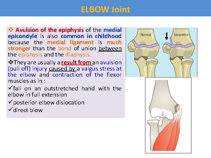 ELBOW Joint v Avulsion of the epiphysis of the medial epicondyle is also common