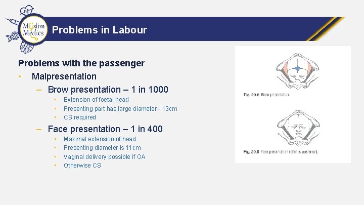 Problems in Labour Problems with the passenger • Malpresentation – Brow presentation – 1