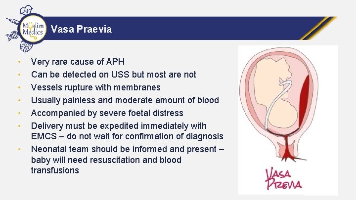 Vasa Praevia • • Very rare cause of APH Can be detected on USS
