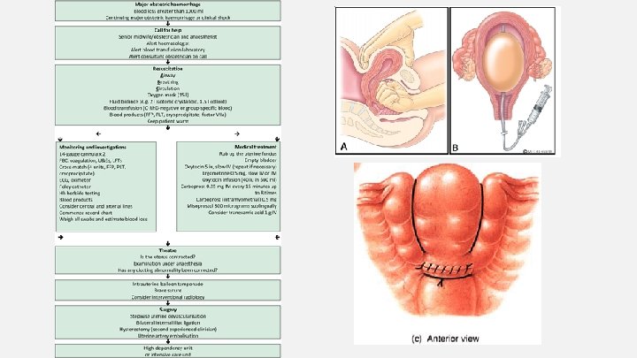 Post-Partum Haemorrhage 