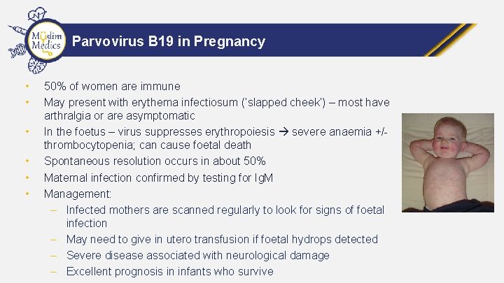 Parvovirus B 19 in Pregnancy • • • 50% of women are immune May