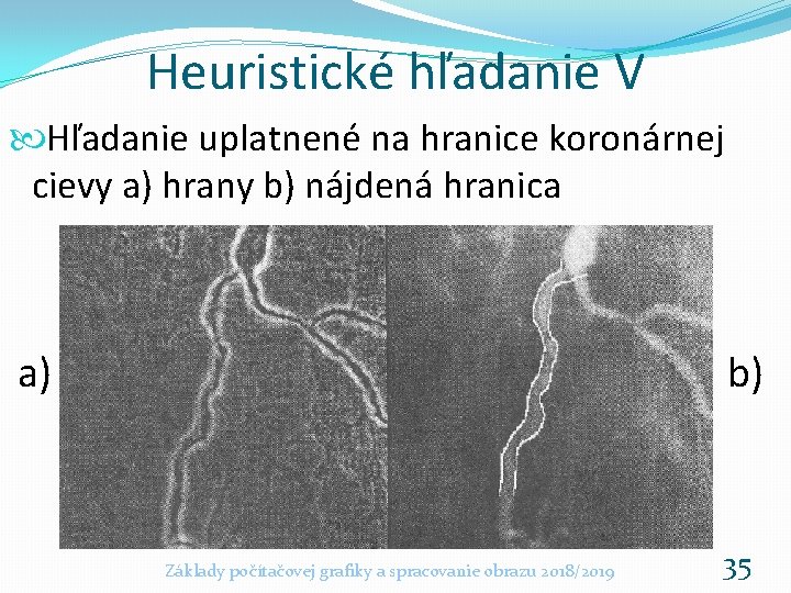 Heuristické hľadanie V Hľadanie uplatnené na hranice koronárnej cievy a) hrany b) nájdená hranica