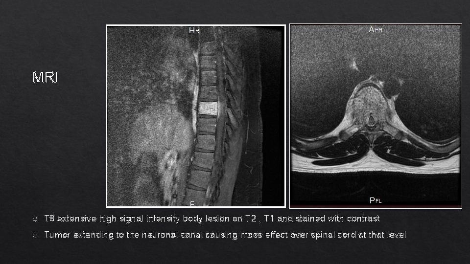 MRI T 8 extensive high signal intensity body lesion on T 2 , T