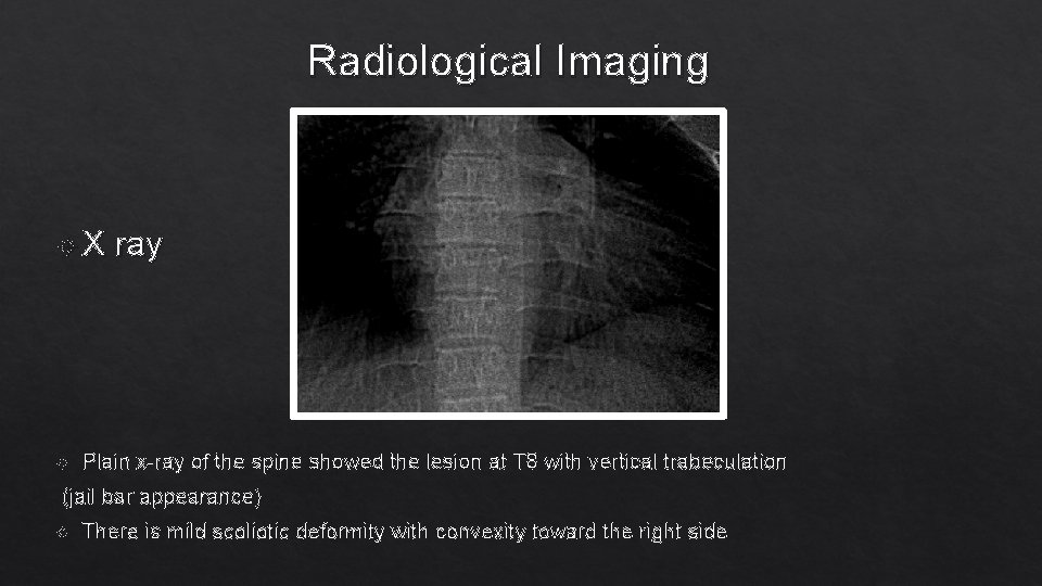 Radiological Imaging X ray Plain x-ray of the spine showed the lesion at T