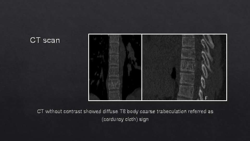 CT scan CT without contrast showed diffuse T 8 body coarse trabeculation referred as