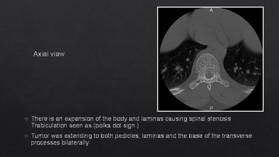 Axial view There is an expansion of the body and laminas causing spinal stenosis